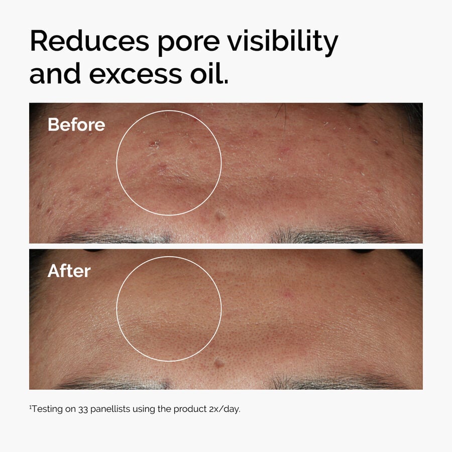 niacinamide-10-zinc-1-j0 ord-niacinamide-zinc-blemish-serum-before-after-pores.jpg