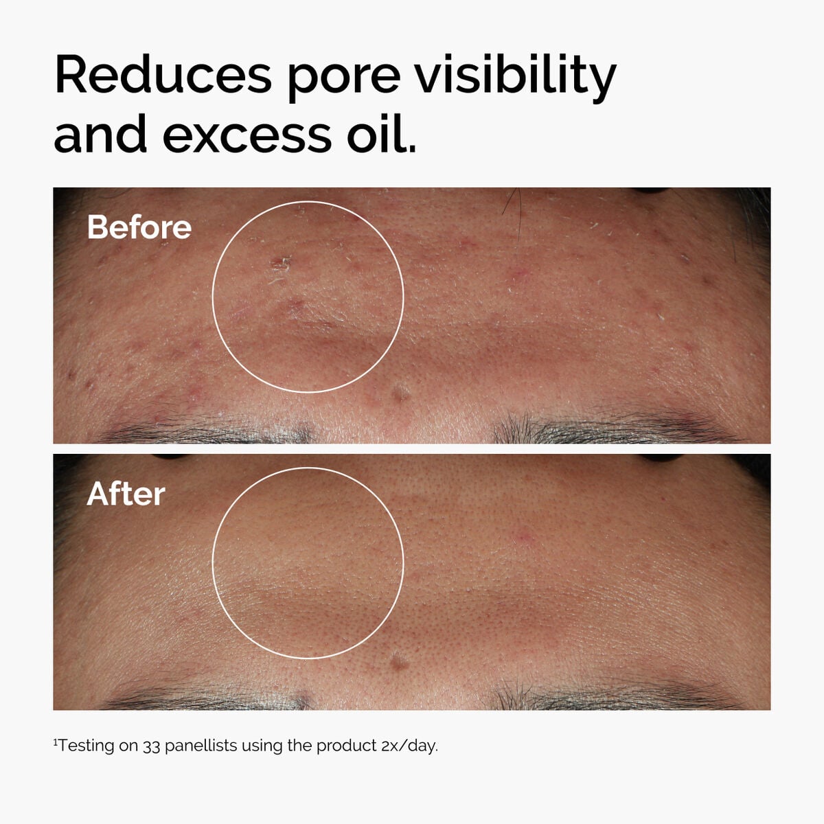 niacinamide-10-zinc-1-j0 ord-niacinamide-zinc-blemish-serum-before-after-pores.jpg