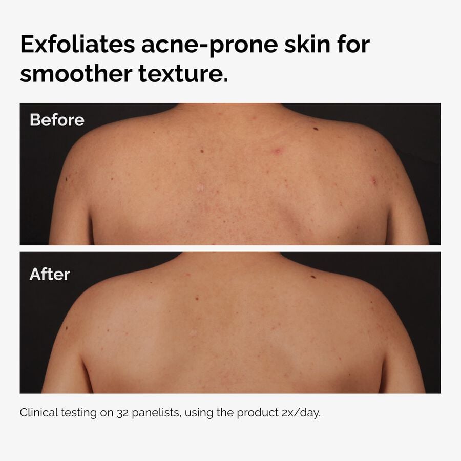 the-body-care-collection-e2 ord-salicylic-acid-body-serum-before-after-graphic-NA.jpg
